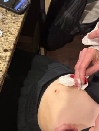 Gauze held against a child's abdomen after a bleeding infusion-site change