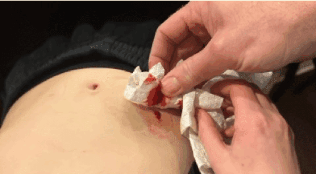 T1D blood belly