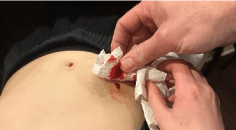 T1D blood belly