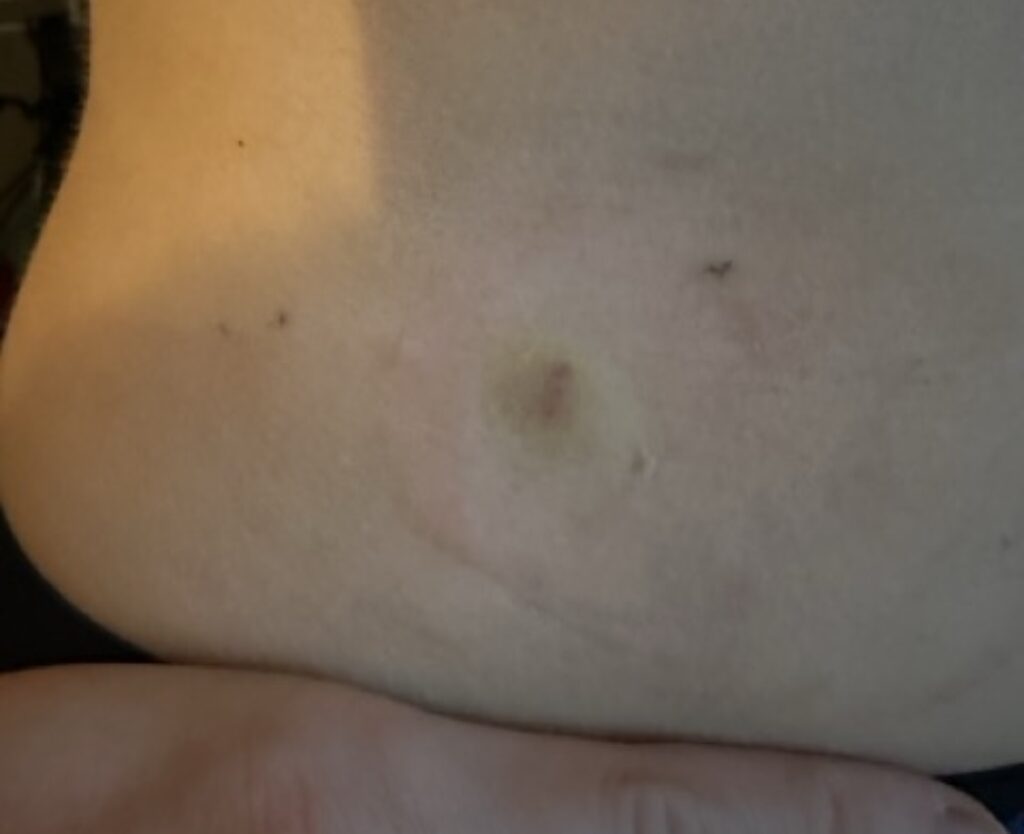 omni pod 5 hole after bleeding